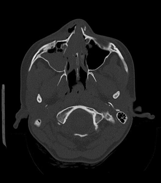 File:Nasoorbitoethmoid fracture (Radiopaedia 90044-107205 Axial bone window 66).jpg