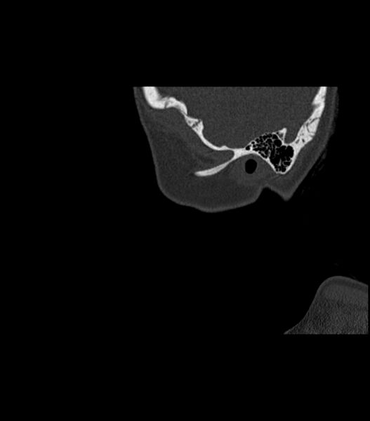 File:Nasoorbitoethmoid fracture (Radiopaedia 90044-107205 Sagittal bone window 17).jpg
