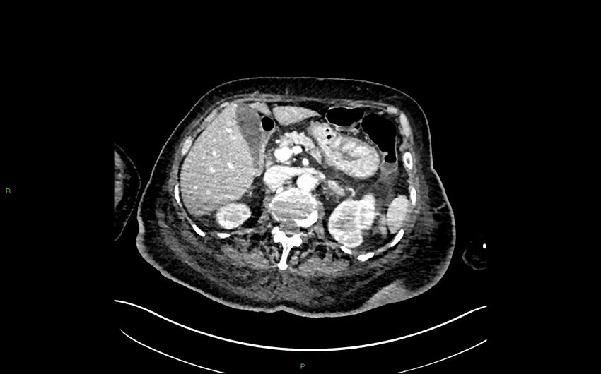 Neo-terminal ileal stricture (Crohn disease) (Radiopaedia 33790-34948 A 137).jpg