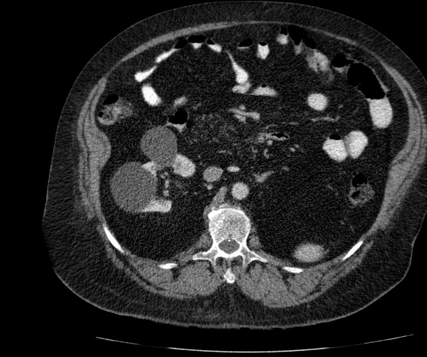 Nephroptosis with inguinal hernia containing perirenal fat (Radiopaedia 56632-63391 C 144).jpg