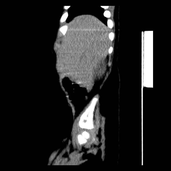 File:Neuroblastoma with skull metastases (Radiopaedia 30326-30960 B 6).jpg
