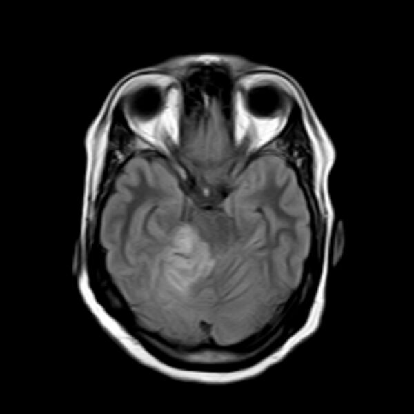 File:Neurofibromatosis type 2 (Radiopaedia 67470-76871 Axial FLAIR 8).jpg