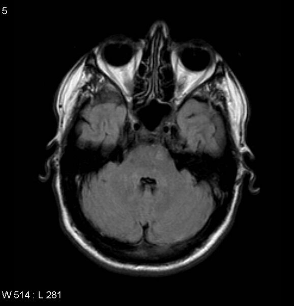 File:Neurosarcoidosis (Radiopaedia 10930-17204 Axial FLAIR 5).jpg