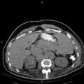 Non Hodgkin lymphoma in a patient with ankylosing spondylitis (Radiopaedia 84323-99621 Axial non-contrast 32).jpg