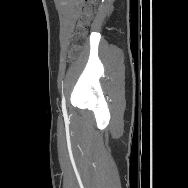 File:Normal CT angiogram of pelvis (Radiopaedia 45390-49430 C 52).jpg
