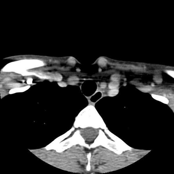 File:Normal CT of the neck (Radiopaedia 14575-14500 Axial C+ 65).jpg