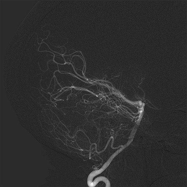 File:Normal cerebral angiogram (four vessel DSA) (Radiopaedia 41708-44649 L 8).png