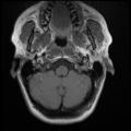 Normal cervical and thoracic spine MRI (Radiopaedia 35630-37156 Axial T1 34).png