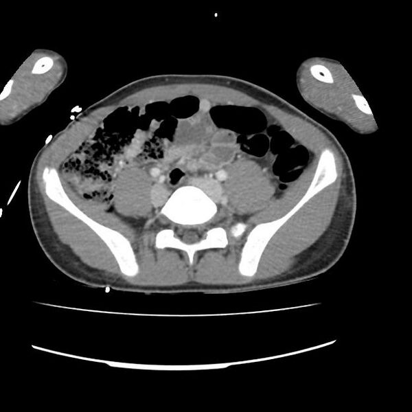 File:Normal dual-phase trauma CT chest,abdomen and pelvis (Radiopaedia 48092-52899 A 88).jpg