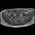 Normal female pelvis MRI (retroverted uterus) (Radiopaedia 61832-69933 Axial T1 11).jpg