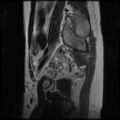Normal female pelvis MRI (retroverted uterus) (Radiopaedia 61832-69933 Sagittal T2 27).jpg