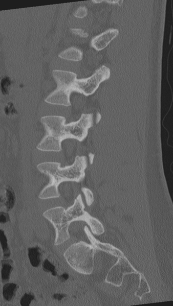 File:Normal lumbar spine CT (Radiopaedia 46533-50986 Sagittal bone window 63).png