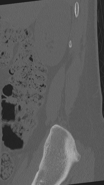 File:Normal lumbar spine CT (Radiopaedia 46533-50986 Sagittal bone window 98).png
