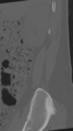 Normal lumbar spine CT (Radiopaedia 46533-50986 Sagittal bone window 98).png