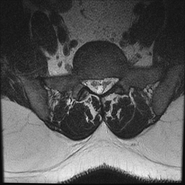 File:Normal lumbar spine MRI (Radiopaedia 43051-46311 Axial T2 25).jpg