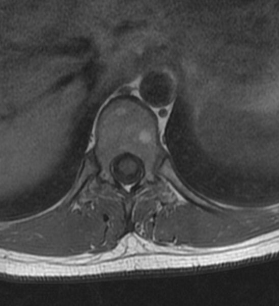 File:Normal thoracic spine MRI (Radiopaedia 41033-43781 Axial T1 15).jpg
