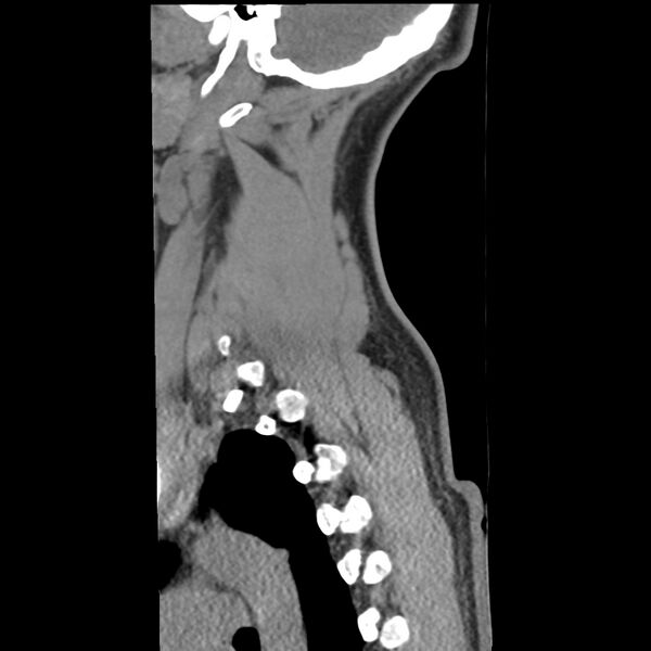 File:Normal trauma spine imaging (Radiopaedia 31753-32686 A 38).jpg