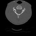 Normal trauma spine imaging (age 16) (Radiopaedia 45335-49358 Axial bone window 22).jpg