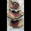 Placenta percreta (gross pathology) (Radiopaedia 77547).jpeg