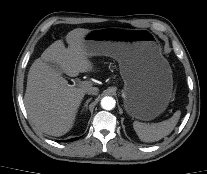File:Abdominal aortic aneurysm (Radiopaedia 22421-22458 C+ arterial phase 8).jpg