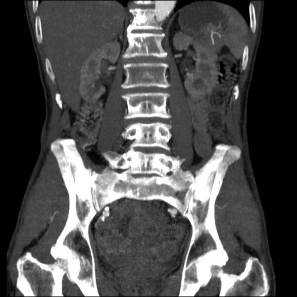 File:Abdominal aortic aneurysm (Radiopaedia 23703-23856 Coronal C+ arterial phase 21).jpg