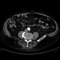 Abdominal aortic aneurysm (Radiopaedia 25855-26001 Axial C+ arterial phase 85).jpg