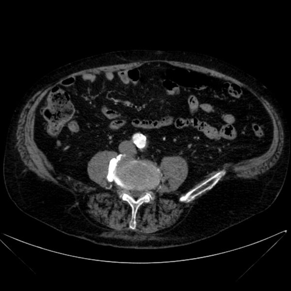 File:Abdominal aortic aneurysm (Radiopaedia 25855-26001 Axial C+ arterial phase 85).jpg