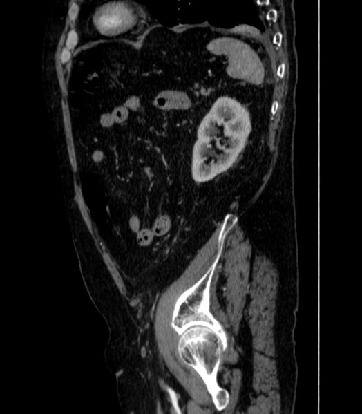 File:Abdominal aortic aneurysm (Radiopaedia 25855-26001 Sagittal C+ arterial phase 66).jpg