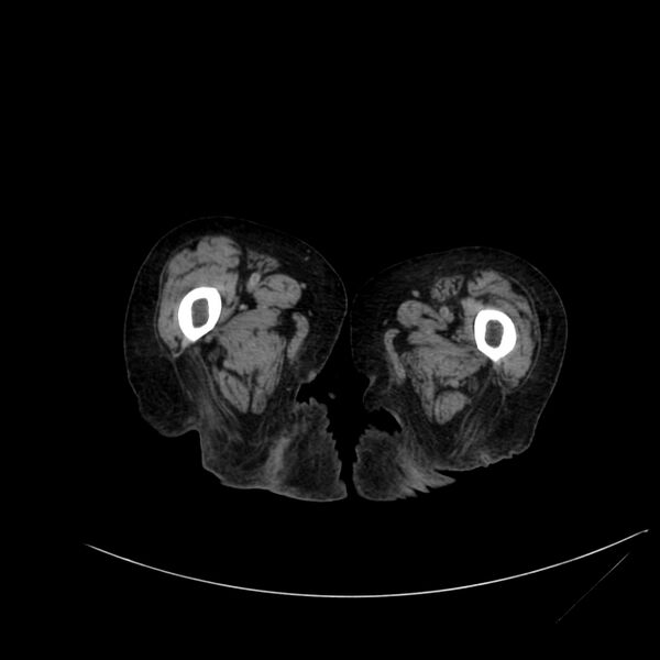 File:Abdominal aortic aneurysm - impending rupture (Radiopaedia 19233-19246 Axial non-contrast 151).jpg