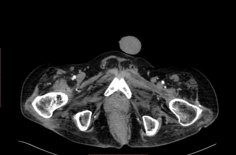 File:Abdominal aortic interposition tube graft and aneurysm thrombosis (Radiopaedia 71438-81857 Axial C+ arterial phase 258).jpg