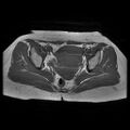 Abdominal wall endometriosis (Radiopaedia 83702-98847 Axial T1 10).jpg