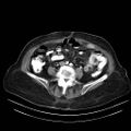 Abdominal wall recurrence after colorectal resection for cancer (Radiopaedia 23444-23523 Axial C+ portal venous phase 21).jpg