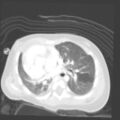 Aberrant left pulmonary artery (pulmonary sling) (Radiopaedia 42323-45435 Axial lung window 20).jpg