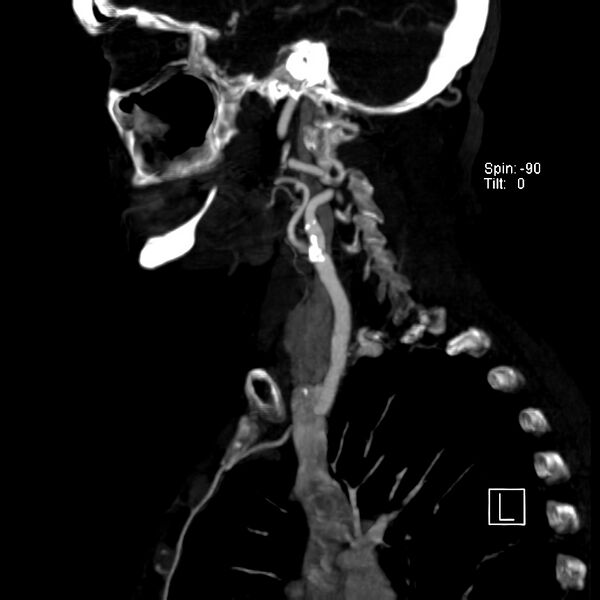 File:Aberrant right subclavian artery (Radiopaedia 22395-22430 Sagittal C+ arterial phase 13).jpg