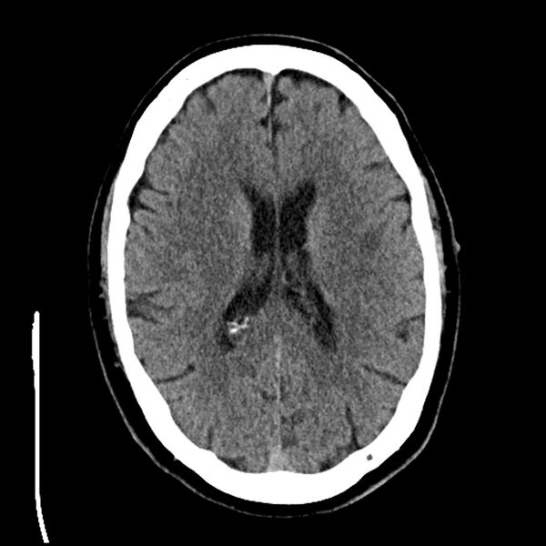 File:Acute A3 occlusion with ACA ischemic penumbra (CT perfusion) (Radiopaedia 72036-82525 Axial non-contrast 27).jpg