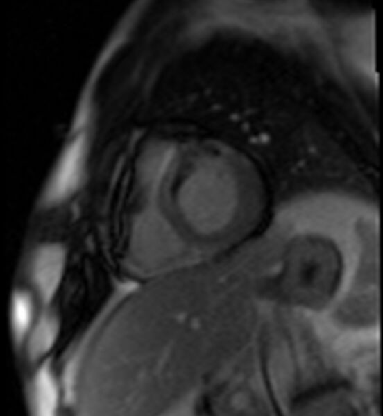File:Acute anteroseptal myocardial infarction (Radiopaedia 68409-77945 Short axis (basal) Perfusion 45).jpg