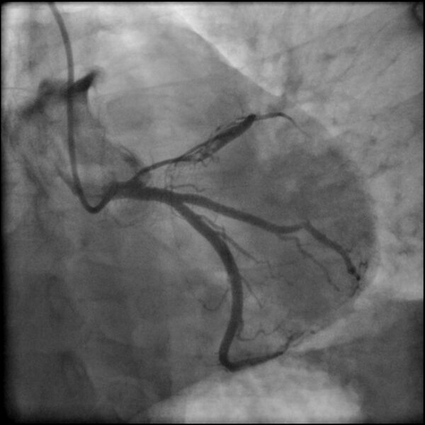 File:Acute anteroseptal myocardial infarction (Radiopaedia 68409-77946 LAO caudal (spider view) LAD and CX 27).jpg