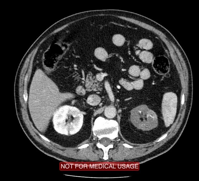 File:Acute aortic dissection - Stanford type A (Radiopaedia 40661-43285 Axial C+ portal venous phase 92).jpg