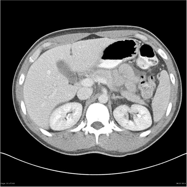 File:Acute appendicitis (Radiopaedia 25364-25615 B 15).jpg