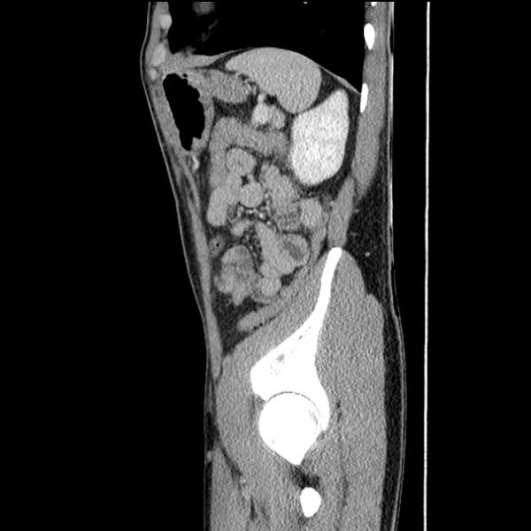 File:Acute appendicitis (Radiopaedia 27049-27227 Sagittal C+ portal venous phase 64).jpg