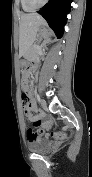 File:Acute appendicitis (Radiopaedia 62608-70901 Sagittal C+ portal venous phase 8).jpg