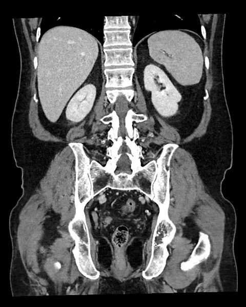 File:Acute appendicitis - large appendicoliths (Radiopaedia 61805-69820 Coronal C+ portal venous phase 96).jpg