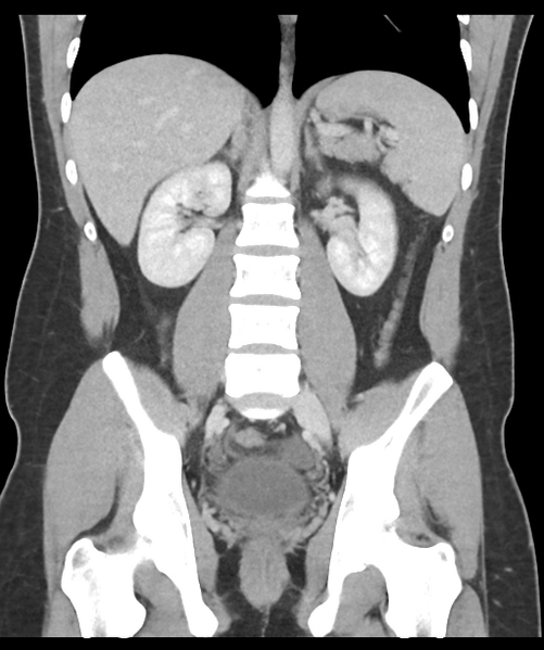 File:Acute appendicitis with appendicoliths (Radiopaedia 50186-55532 Coronal C+ portal venous phase 34).png