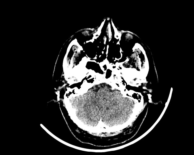 File:Acute cerebral infarct (Radiopaedia 35604-37123 Axial non-contrast 18).jpg