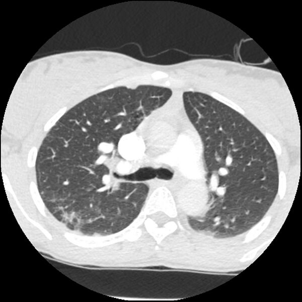 File:Acute chest syndrome - sickle cell disease (Radiopaedia 42375-45499 Axial lung window 70).jpg