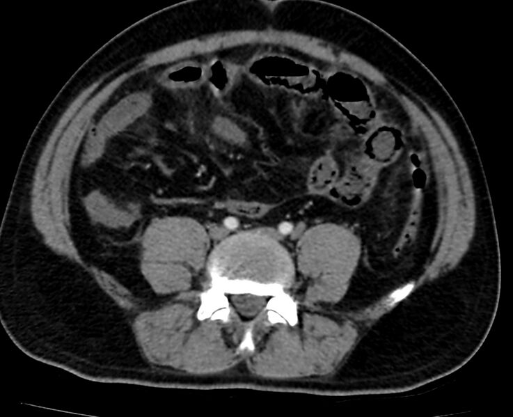 File:Acute mesenteric ischemia - superior mesenteric artery thrombosis (Radiopaedia 73947-84776 Axial C+ arterial phase 102).jpg