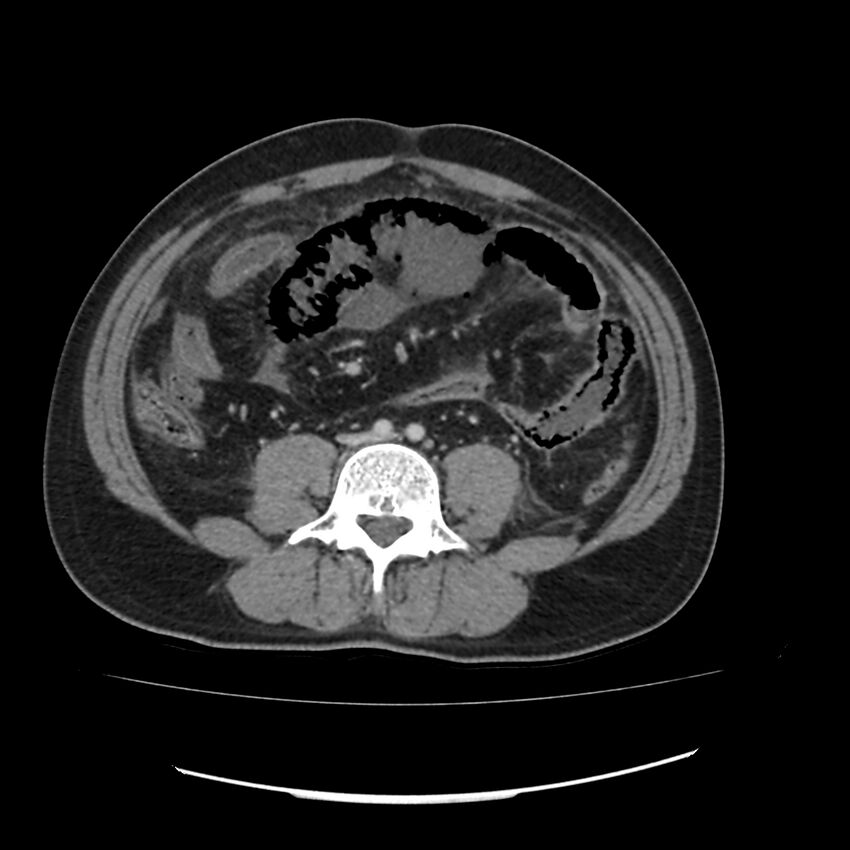 Acute mesenteric ischemia - superior mesenteric artery thrombosis (Radiopaedia 73947-84776 Axial C+ portal venous phase 96).jpg