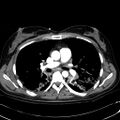 Acute myocardial infarction in CT (Radiopaedia 39947-42415 Axial C+ arterial phase 61).jpg