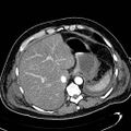 Acute pancreatic necrosis (Radiopaedia 13560-13486 Axial C+ portal venous phase 31).jpg