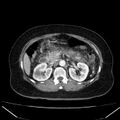 Acute pancreatitis - Balthazar C (Radiopaedia 26569-26714 Axial C+ arterial phase 34).jpg